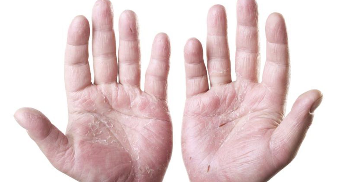 Потрескавшаяся кожа на руках – серьезная проблема
